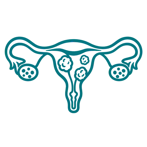 Uterine Fibroids
